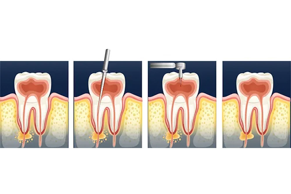 Endodontics