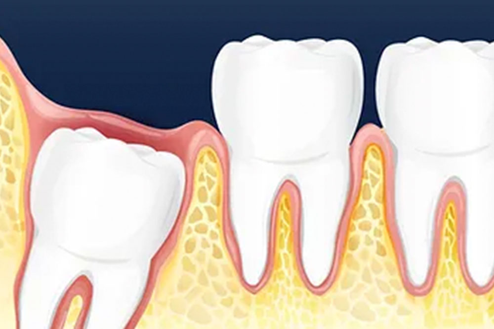 Tooth Extractions