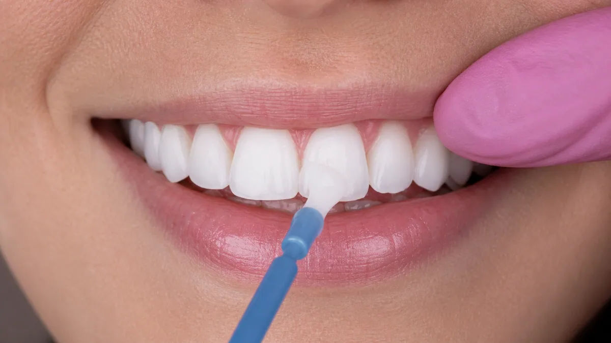 Fluoride treatment in North York being applied to a patient's front teeth with a varnish applicator brush.