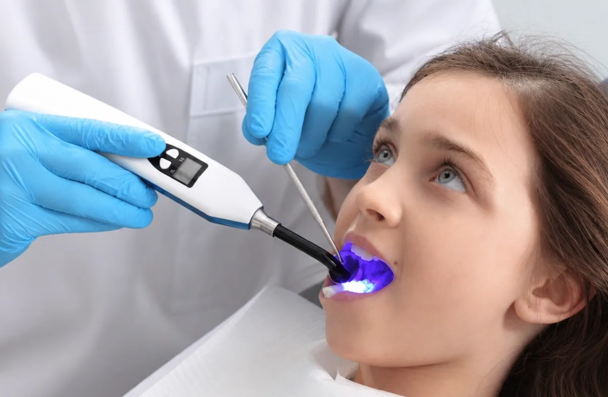 Dental Sealants in North York | Cavity Prevention for Kids & Adults Dental sealants in North York being applied to a young patient's molars using a curing light.