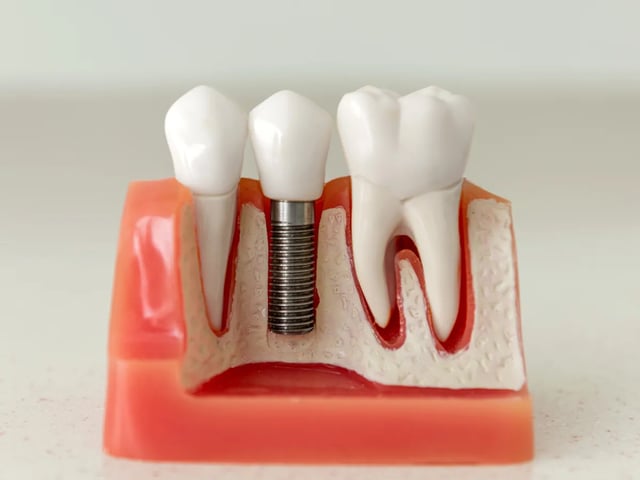 Dental Implants: Why Titanium Works Best