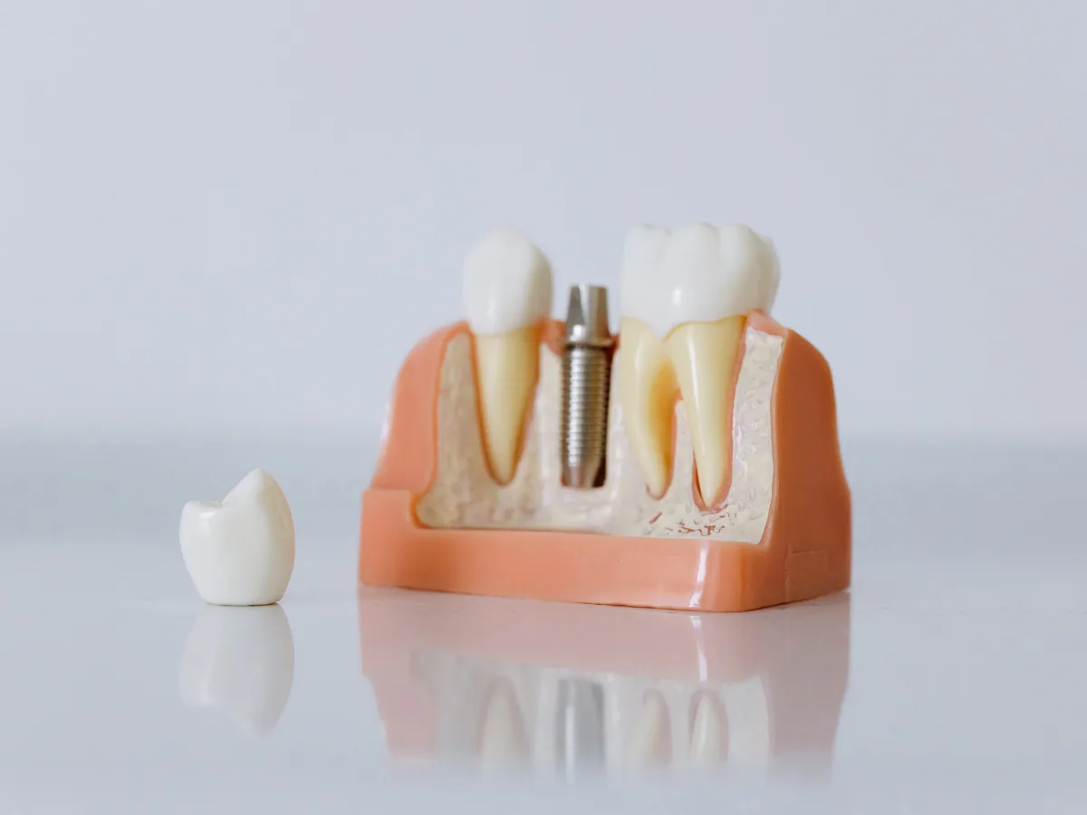 Dental Implants: Maintenance and Care Protocols