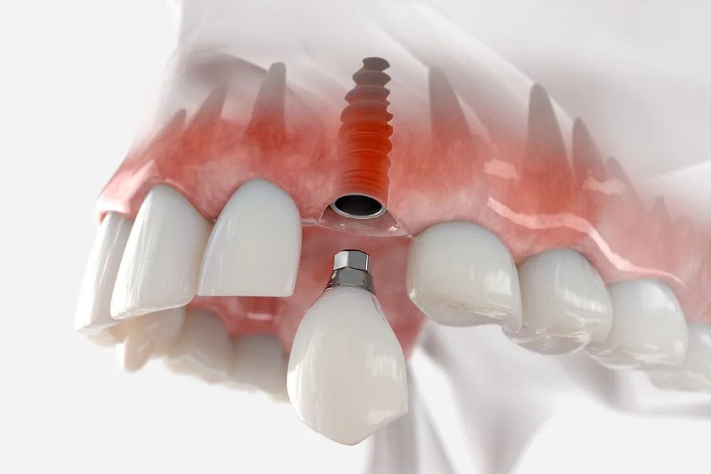 Dental Implants in North York: A Permanent Solution for Missing Teeth